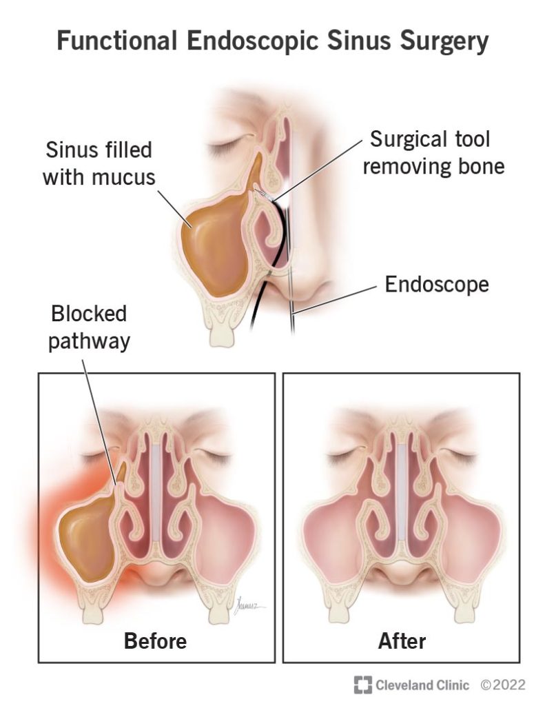 Functional Sinus Endoscopic Surgery in Tucson