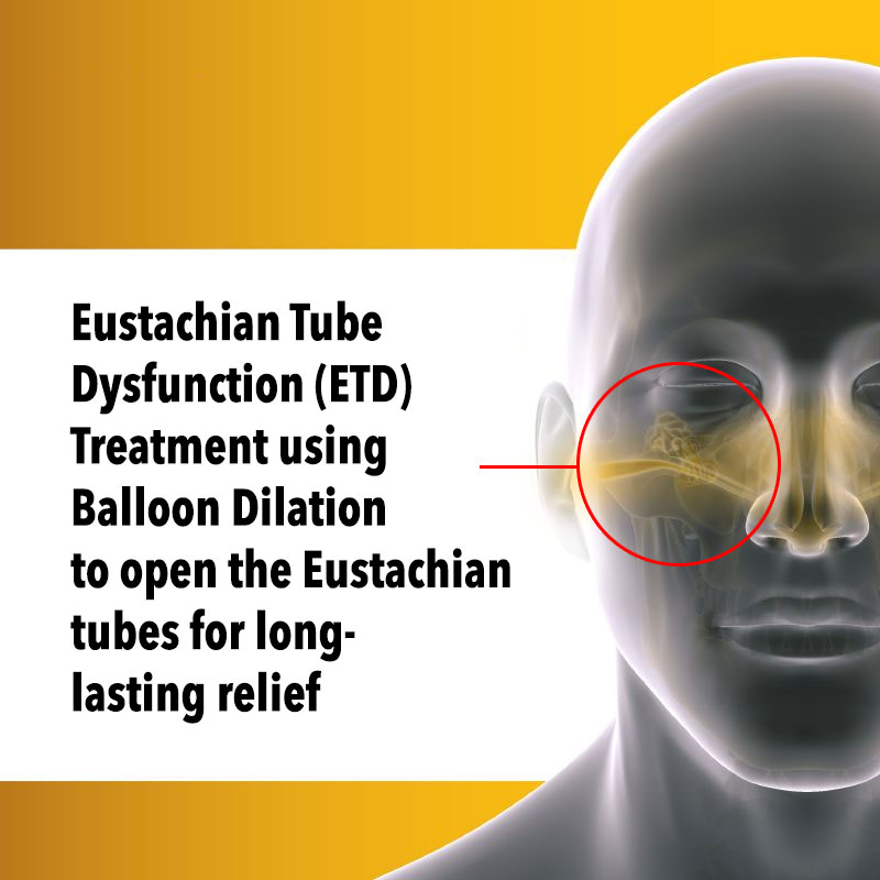 Eustachian Tube Dysfunction (ETD) treatment, Tucson Arizona