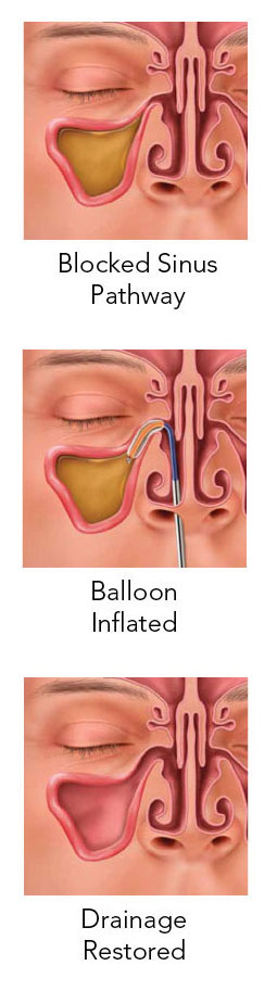 Balloon Sinuplasty Treatment by Dr. Adam Ray in Tucson, Arizona